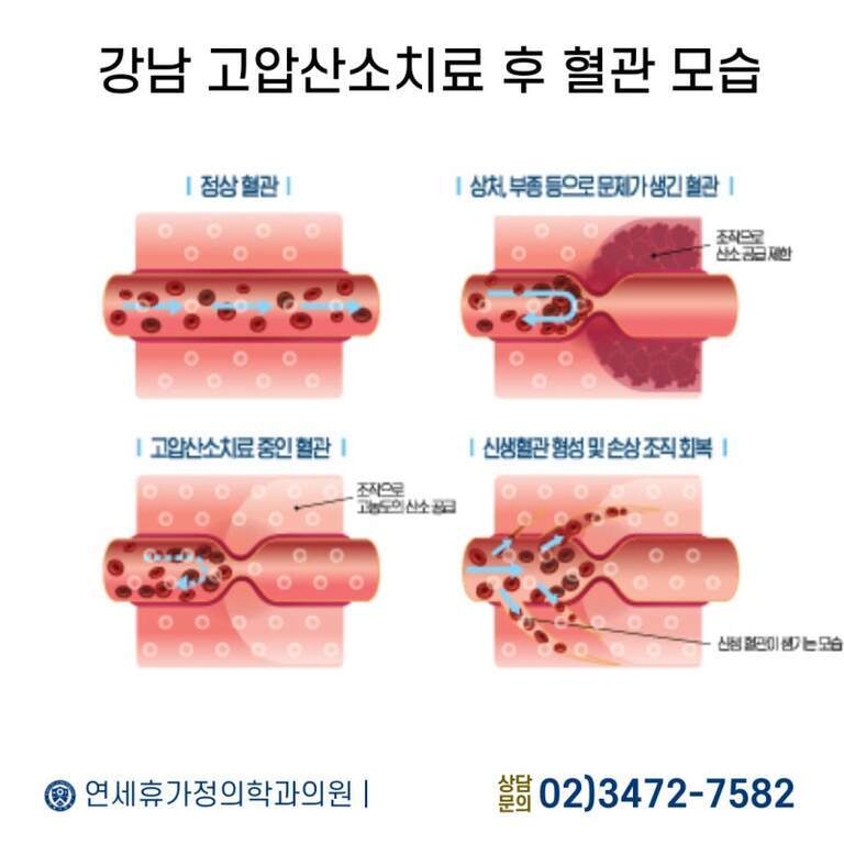 정상 혈관, 손상된 혈관, 고압산소치료 중인 혈관, 신생혈관이 형성되어 조직이 회복되는 과정을 단계별로 보여주는 의료 일러스트. 하단에는 연세휴가정의학과의원과 상담문의 전화번호가 적혀 있음.