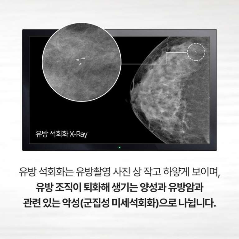유방 석회화 X-ray 사진이 모니터에 표시되어 있으며, 오른쪽 상단의 작은 원 안에는 미세한 흰 점들이 확대되어 보인다. 하단에는 유방 석회화가 양성과 유방암 관련 악성으로 나뉠 수 있음을 설명하는 글이 있다.