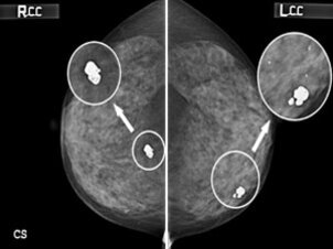 유방의 좌우 측면을 보여주는 유방촬영술(맘모그램) 이미지로, 양쪽에 둥글게 표시된 부분과 화살표로 강조된 석회화 병변이 보인다.