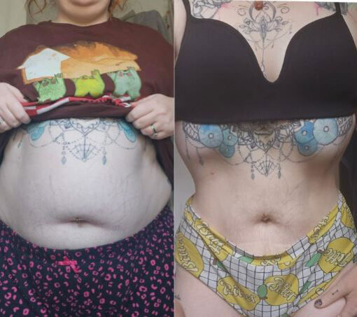 한 여성의 복부 전후 사진. 왼쪽은 체중이 더 나가던 시절이고, 오른쪽은 살이 빠진 후 같은 위치의 문신이 보인다.